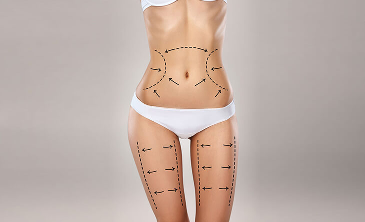 liposuction surgery in delhi