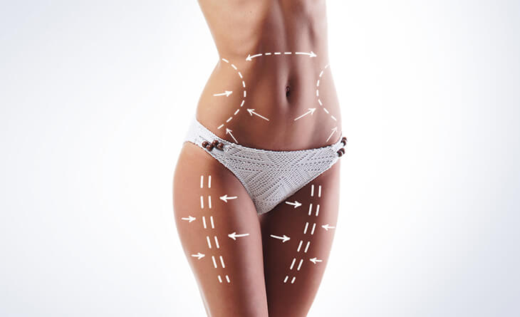 Liposuction Surgery in Delhi