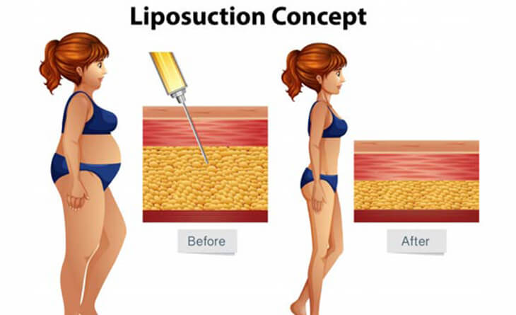 Liposuction Surgery in Delhi