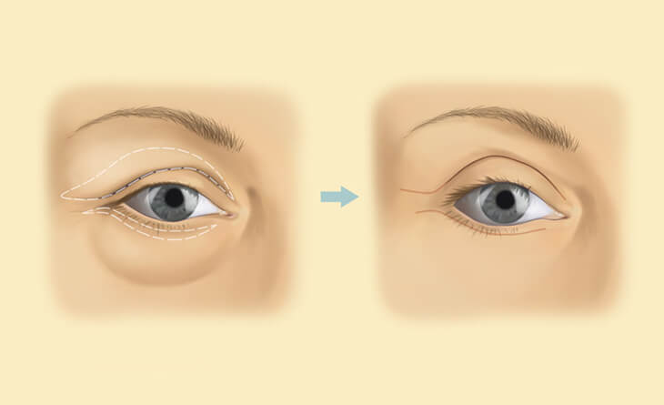 Blepharoplasty Surgery in Delhi