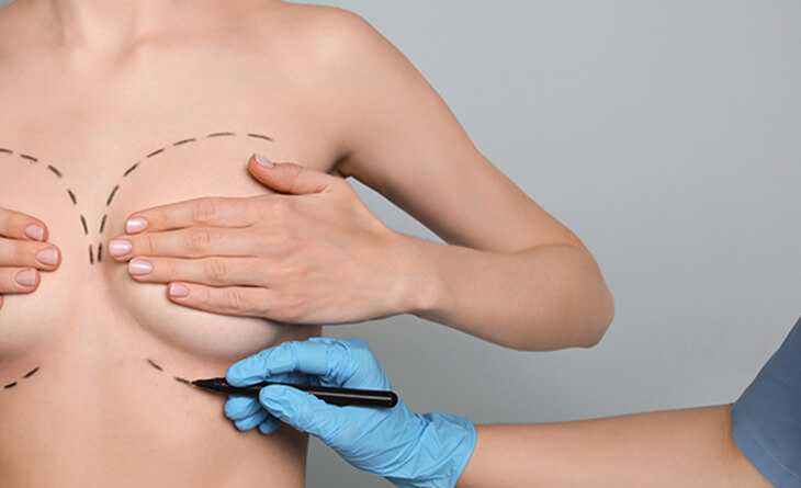 Breast augmentation, Breast Augmentation Surgery, Breast Augmentation Surgery in Delhi, Breast Augmentation Surgery Cost in Delhi, Breast Augmentation Surgery in Delhi