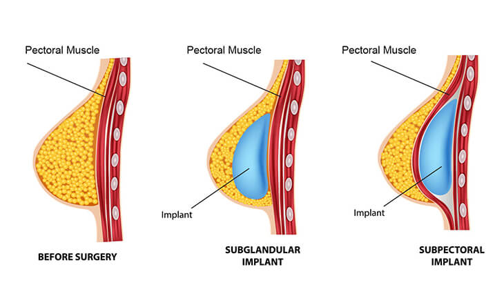 Breast Augmentation Surgery in Delhi