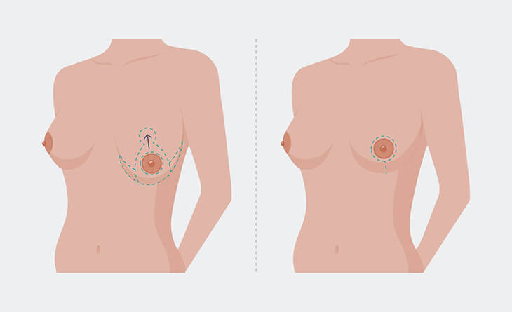 Breast Lift Surgery in Delhi