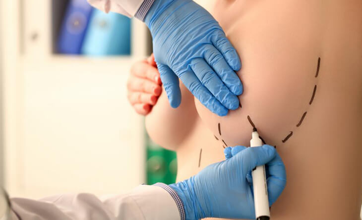 Breast Reduction Surgery in Delhi