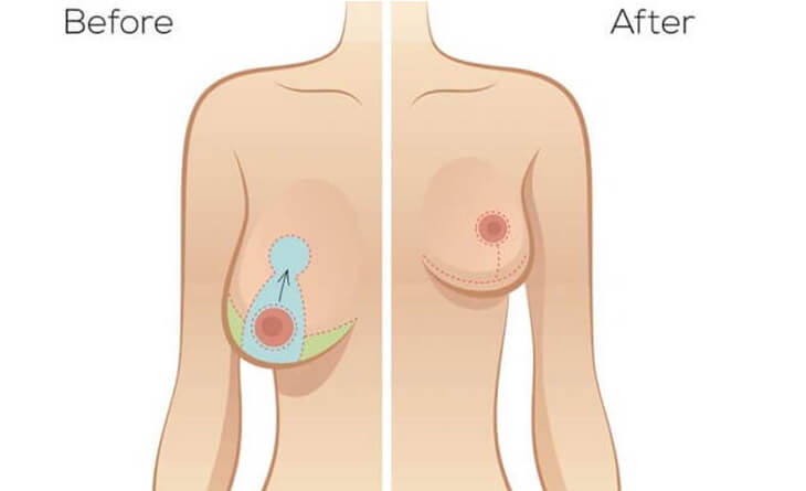 Breast Reduction Surgery in Delhi