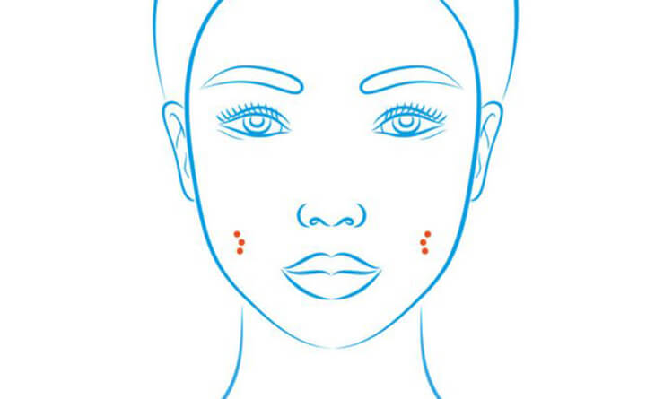 Dimple Creation Surgery - Dr Lokesh Handa - Plastic Surgeon in Delhi -02 Dimple Creation Surgery in Delhi