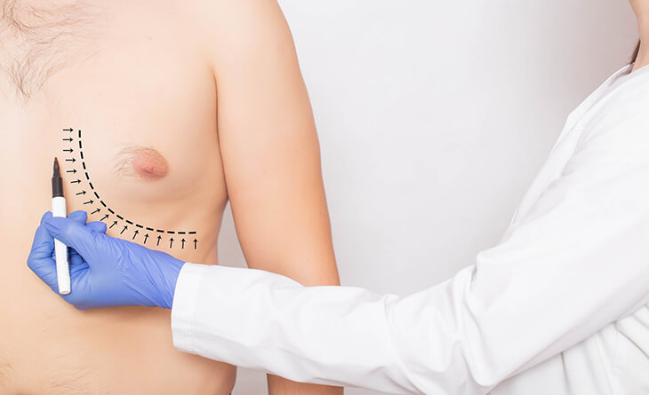 Gynecomastia Surgery - Dr Lokesh Handa -Plastic Surgeon in Delhi -01 Gynecomastia Surgery in Delhi