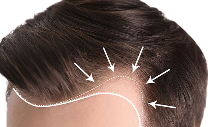 Hair Transplant in Delhi | Dr. Lokesh Handa - Med Esthetiks Hair Transplant in Delhi | Dr. Lokesh Handa - Med Esthetiks