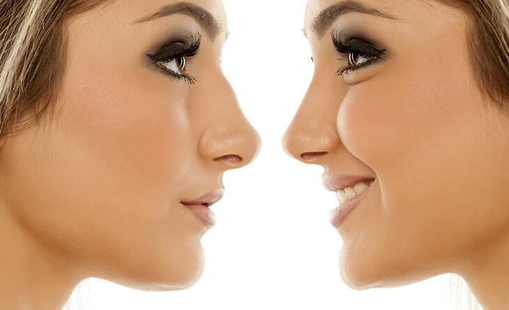 Rhinoplasty in Delhi