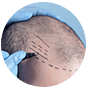 hair transplant in delhi