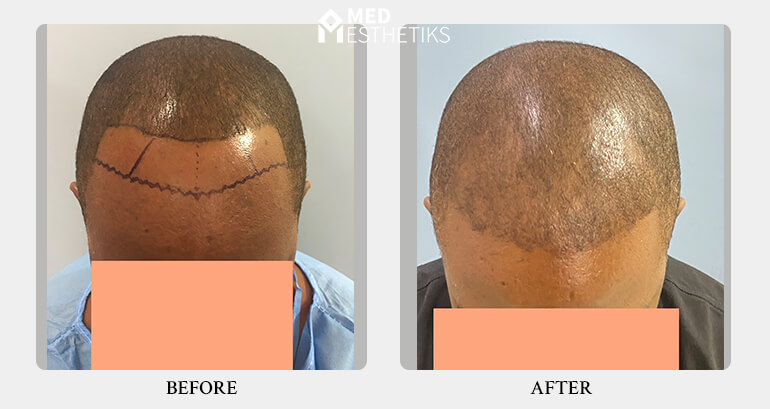 AFRO hair transplant - result - Dr Lokesh Handa -012