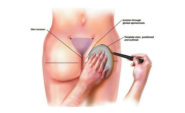 Buttock Augmentation Surgery in Delhi