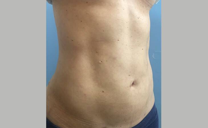 liposuction surgery in delhi liposuction surgery in delhi