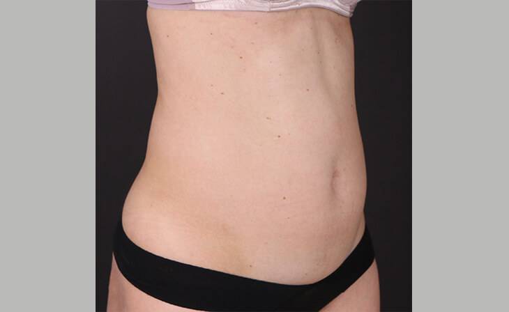 liposuction surgery in delhi liposuction surgery in delhi