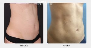 liposuction surgery in delhi