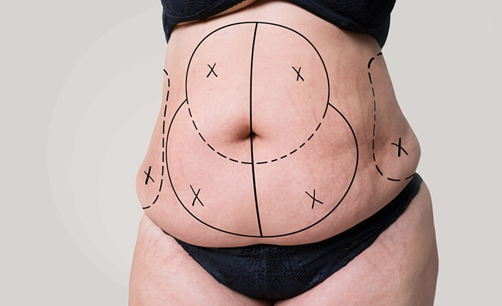 Tummy Tuck Surgery in Delhi