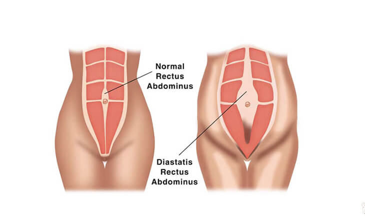 Tummy Tuck Surgery in Delhi