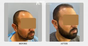 beard hair transplant - result - Dr Lokesh Handa -023