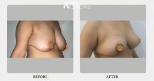 breast reduction and lift -result- Dr Lokesh Handa -01