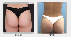 butt augmentation result - Dr Lokesh Handa -12