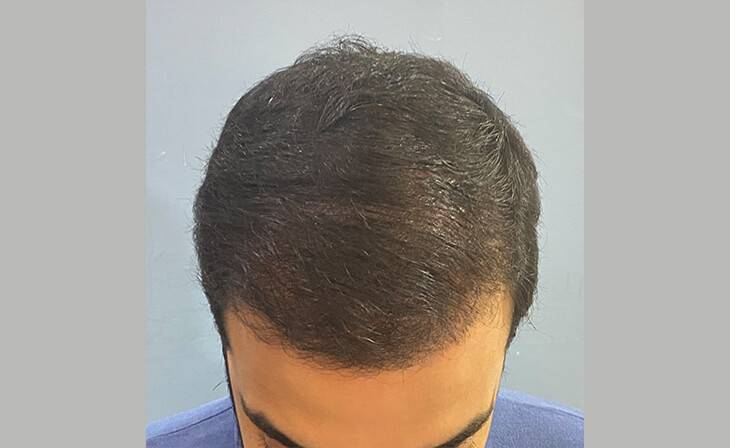 Hair Transplant in Delhi