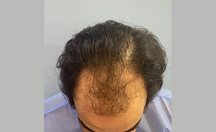 Hair Transplant in Delhi