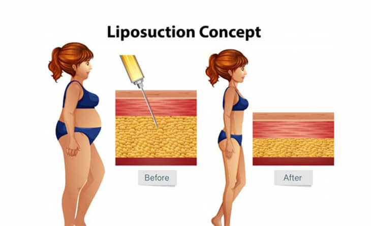 Liposuction Surgery in Delhi