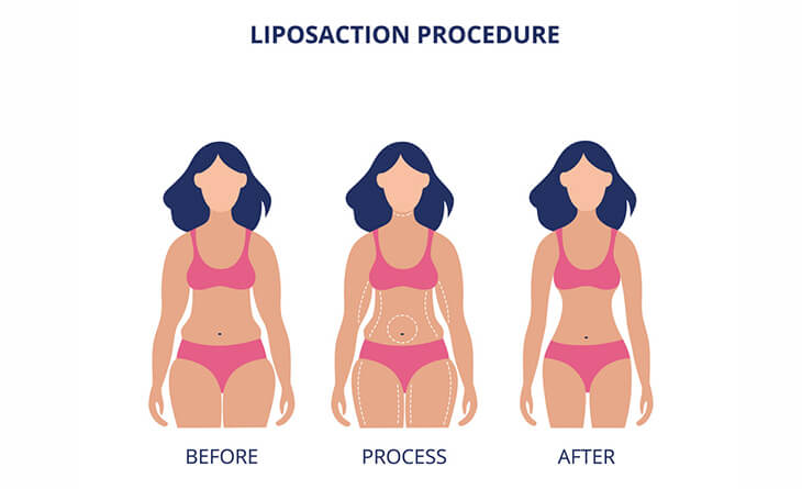 Liposuction Surgery in Delhi