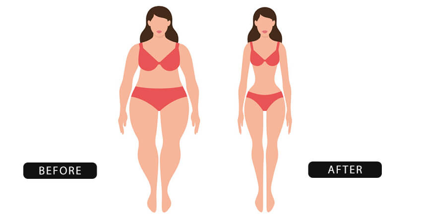 liposuction surgery in Delhi