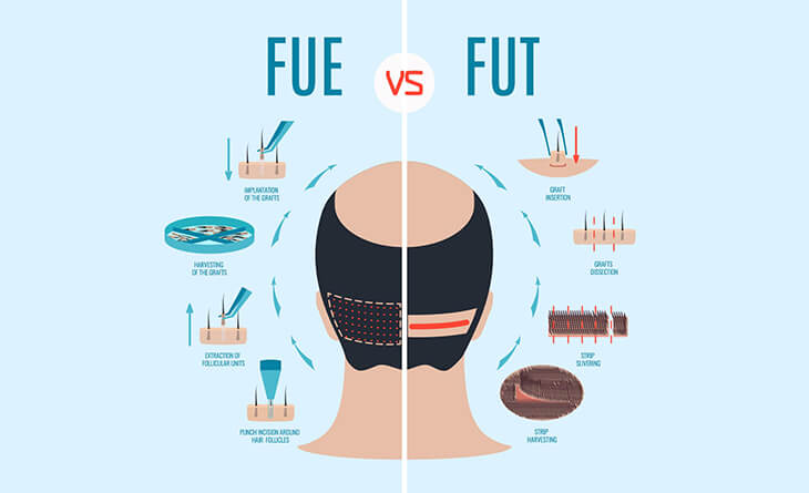 Hair Transplant Clinic in Delhi