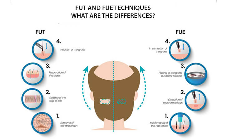 Hair Transplant in Delhi