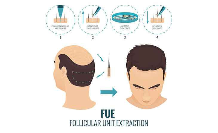 Hair Transplant in Delhi