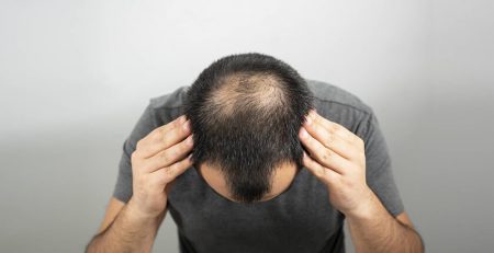 Hair Transplant in Delhi