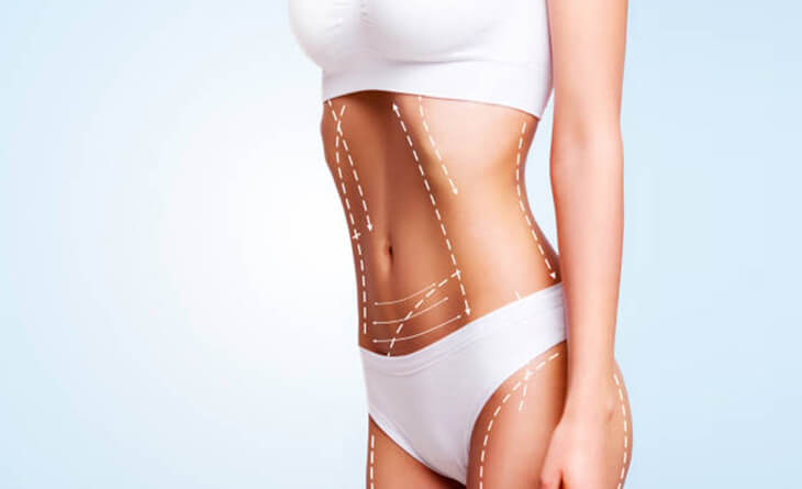 How is Liposuction Surgery Done?