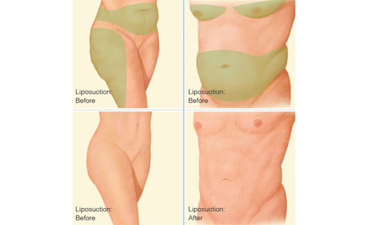 How is Liposuction Surgery Done?