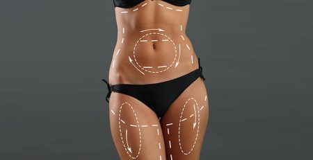 How is Liposuction Surgery Performed?