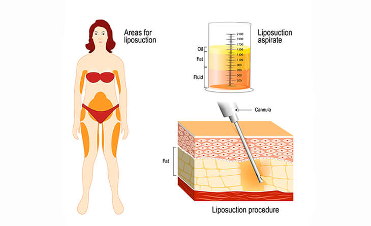 How is Liposuction Surgery Performed?