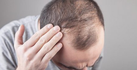 Hair Transplant in Delhi