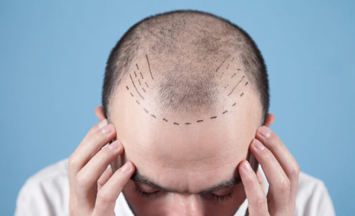 Hair Transplant in Delhi