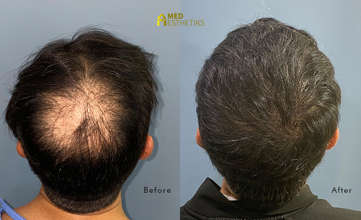 hair transplant in delhi