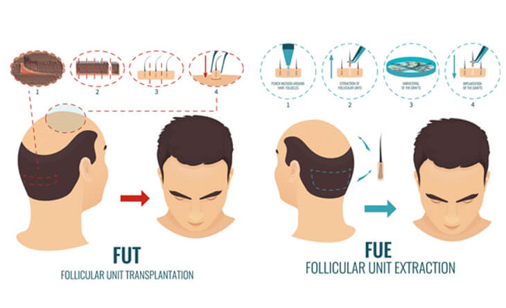 hair transplant in delhi