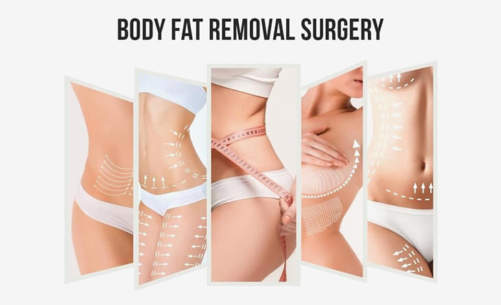 liposuction surgery in delhi