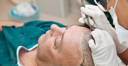 Which Hair Transplant Method is Better?