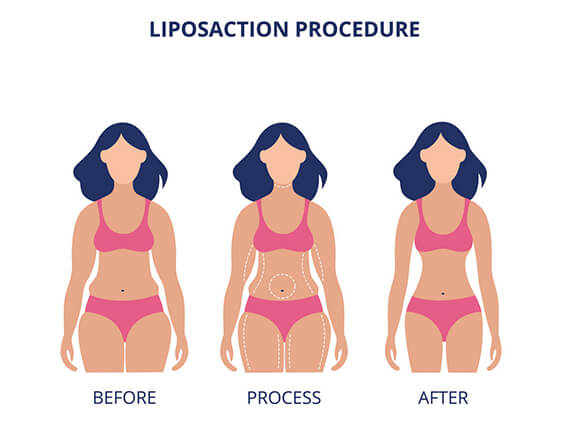 Liposuction Surgery in Delhi