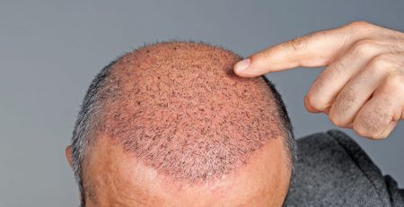 Hair Transplant Cost in Delhi - Dr Lokesh Handa - Best Plastic Surgeon in Delhi