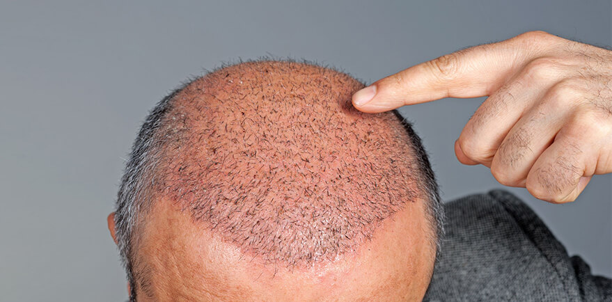 Hair Transplant Cost in Delhi - Dr Lokesh Handa - Best Plastic Surgeon in Delhi