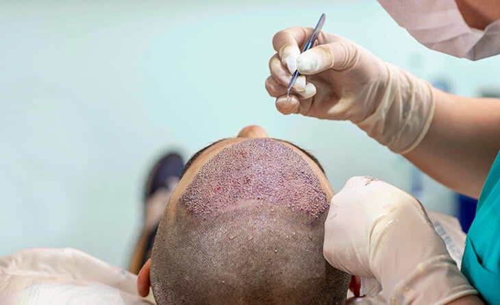 Hair Transplant Cost in Delhi