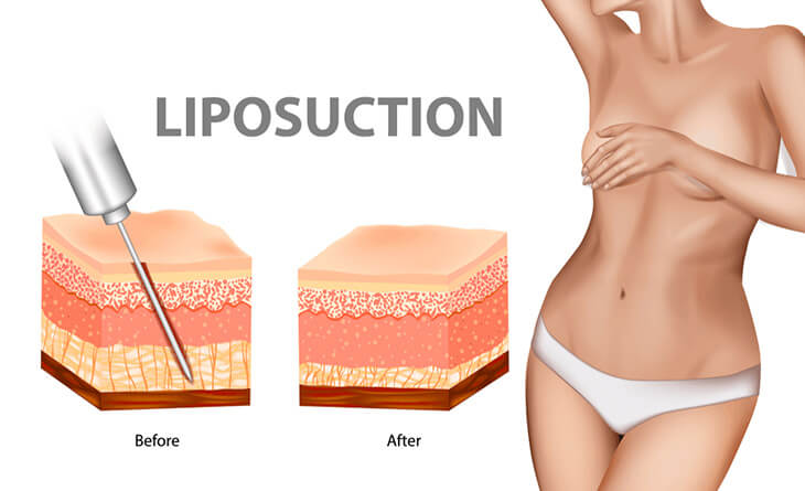 Is Liposuction a Safe Procedure - Dr Lokesh Handa - Best Plastic Surgeon in Delhi -02