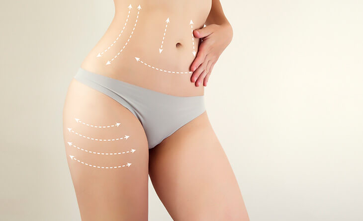 Liposuction Surgery in Delhi