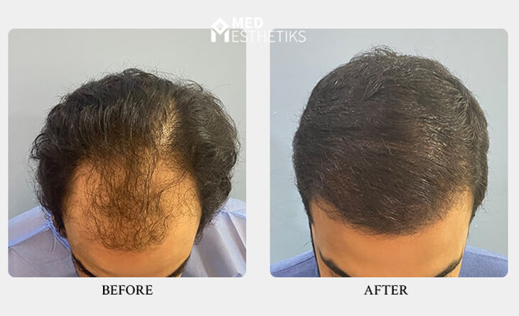 Know Everything About Hair Transplant for Men
